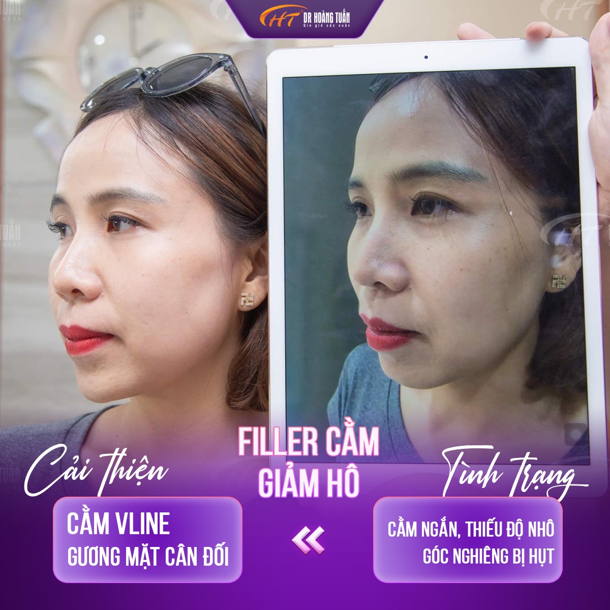 tiêm filler cằm
